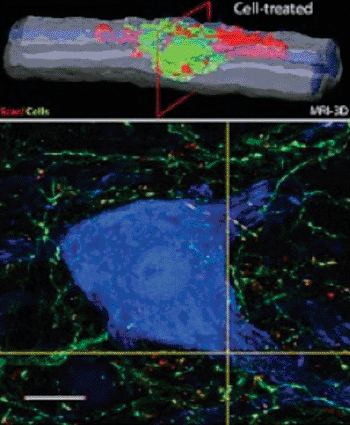 Imagen A: Una imagen de resonancia magnética reconstruida en tres dimensiones (arriba) muestra una cavidad causada por una lesión espinal prácticamente llena de células madre neuronales injertadas, en color verde. La imagen inferior muestra el crecimiento neuronal de las neuronas humanas trasplantadas (verde) y el desarrollo de contactos putativos (puntos amarillos) con las neuronas huésped (azules) (Fotografía cortesía de la Facultad de Medicina de la Universidad de California, San Diego).